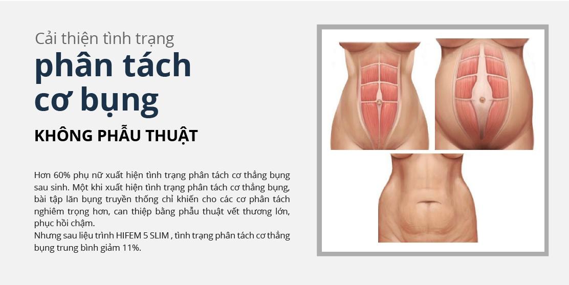 HIỆN TƯỢNG PHÂN TÁCH CƠ BỤNG Ở PHỤ NỮ SAU SINH VÀ GIẢI PHÁP CẢI THIỆN TÌNH TRẠNG PHÂN TÁCH CƠ BỤNG CỦA SIBETECH VIỆT NAM
