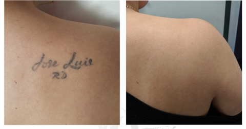 hinh-anh-truoc-sau-tri-lieu-tatoo-laser