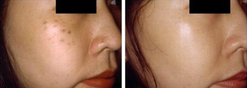 tri-nam- truoc-sau-tri-lieu-tatoo-laser